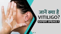जानें क्या है Vitiligo?