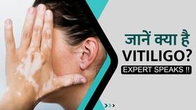 जानें क्या है Vitiligo?