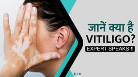 जानें क्या है Vitiligo?