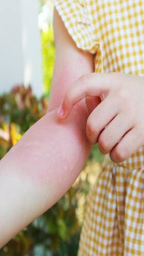 Foods That May Cause Allergies in Children