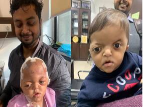 Apert Syndrome: Neurosurgeons Reconstruct Skull Of 9-Month-Old Baby Born With Rare Congenital Disorder
