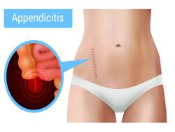 Appendicitis Can Be Life Threatening: Facts You Should Know About This Lesser-Known Condition