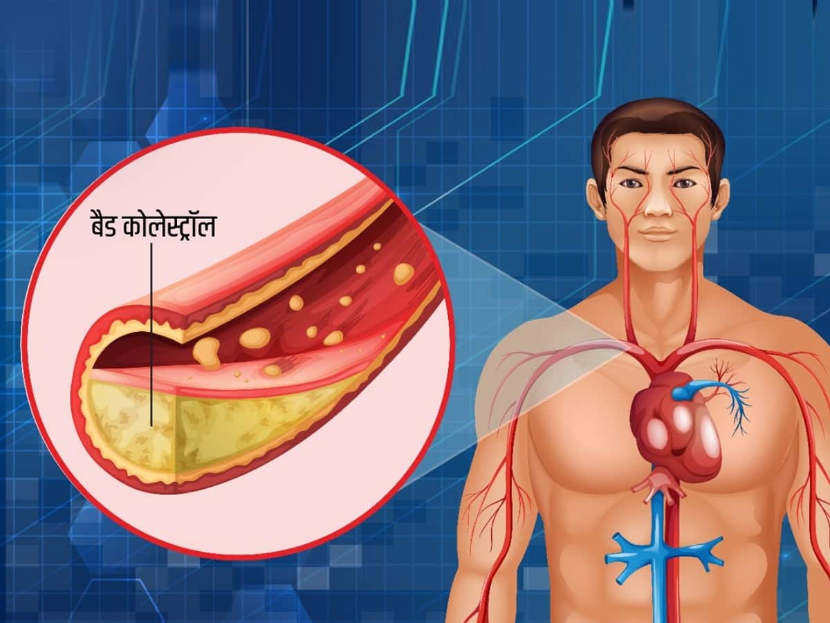 Cholesterol Kam Karne Ke Upay साइलेंट किलर है शरीर में हाई