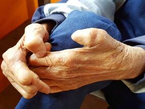 Facts About Leprosy We Should Be Aware Of