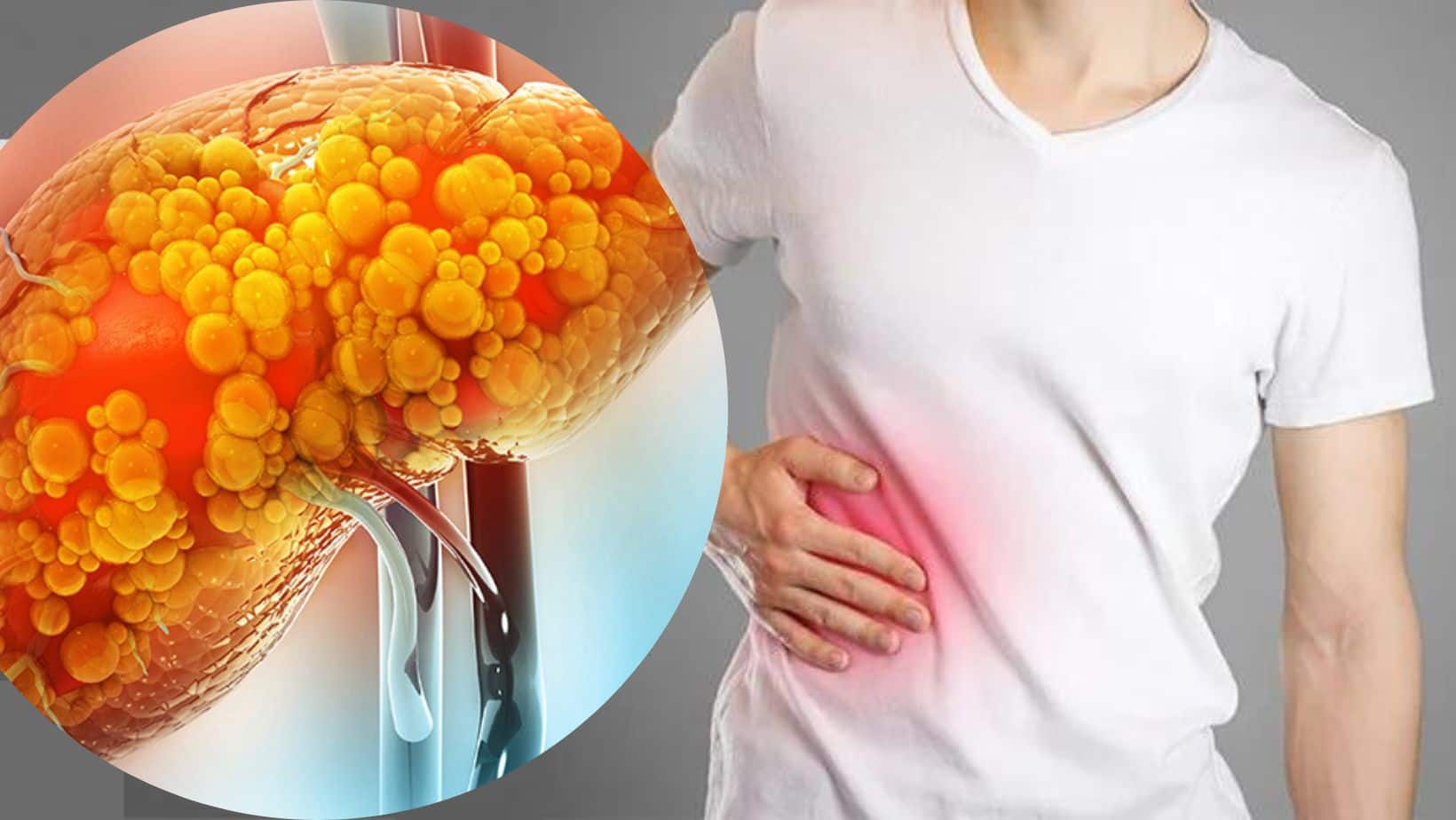 Fatty Liver Excessive Fat Accumulation In The Liver Can Damage Your