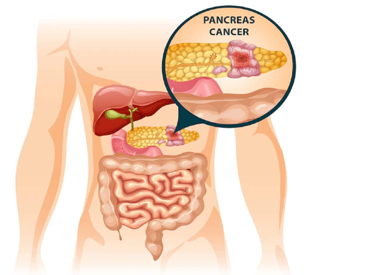 Low-Fat Diet May Cut Pancreatic Cancer: All You Need To Know |  