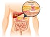 Advancements In Pancreatic Cancer Treatment: Targeted Therapies And Immunotherapies