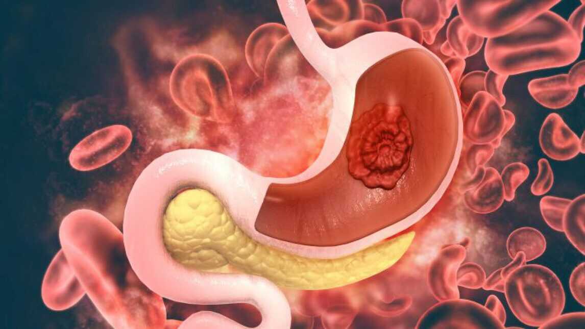 Gastric Cancer: 7 Rarest Types of Stomach Cancer And Their Symptoms