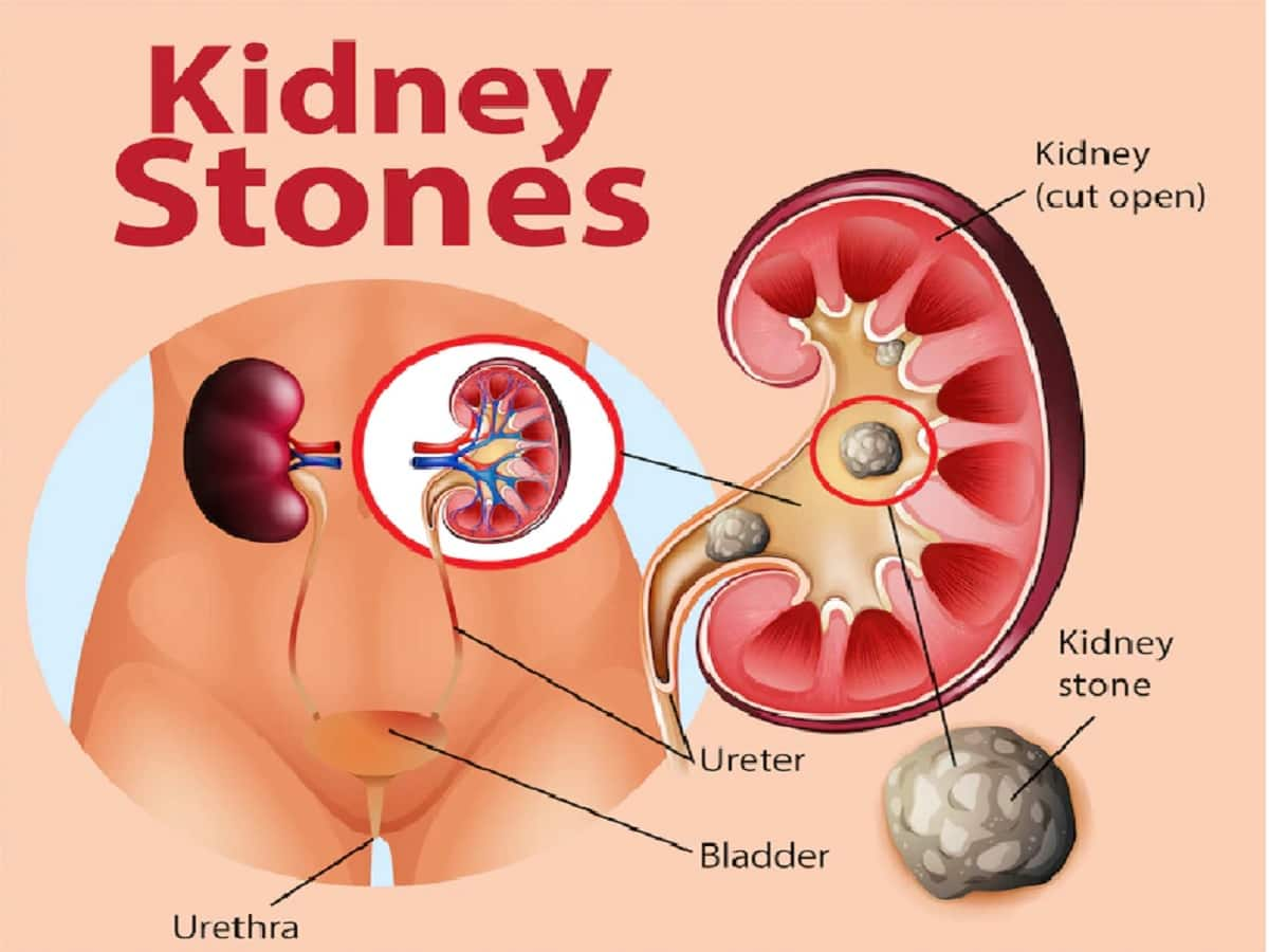 Ayurvedic remedies for kidney stones TheHealthSite