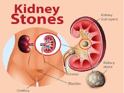 Kidney Stones: Causes, Treatment, Prevention And More As Per Ayurveda