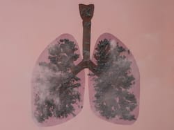 Black Lung Disease: All You Want To Know About This Job-Related Illness