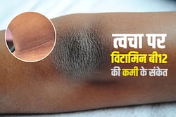 इस विटामिन की कमी से गर्दन और कोहनी हो जाती है काली, जानिए विटामिन और उसके सोर्स