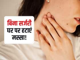 काले-काले भद्दे मस्से खराब कर रहे हैं आपके चेहरे की खूबसूरती? हटाने के लिए अपनाएं ये घरेलू नुस्खे