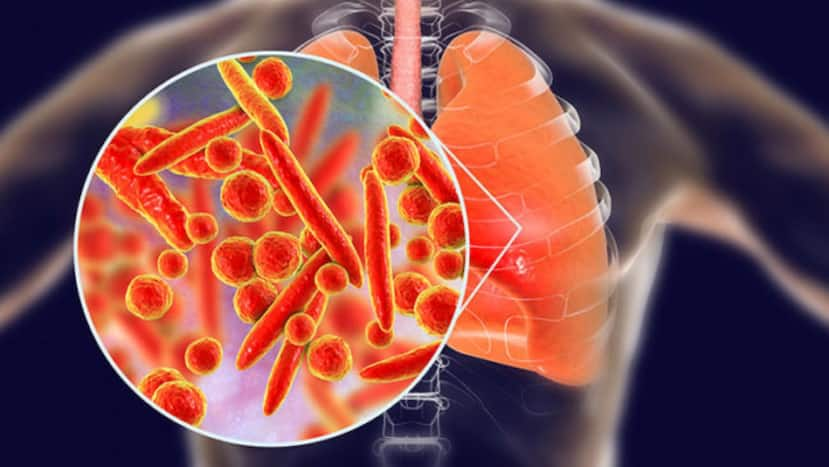 COVID-19 Pneumonia: Chronic Muscle Pain And Other Unusual Symptoms To ...