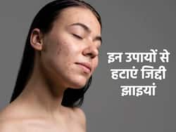 चेहरे पर जिद्दी झाइयों से लोगों के सामने जाने में हो रही है शर्मिंदगी, इन 5 उपायों से पाएं छुटकारा