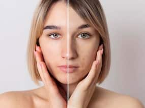 4 Types of Pigmentation: 3 Ayurvedic Ways To Control It