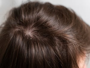 7 Steps To Control Dandruff During Winters