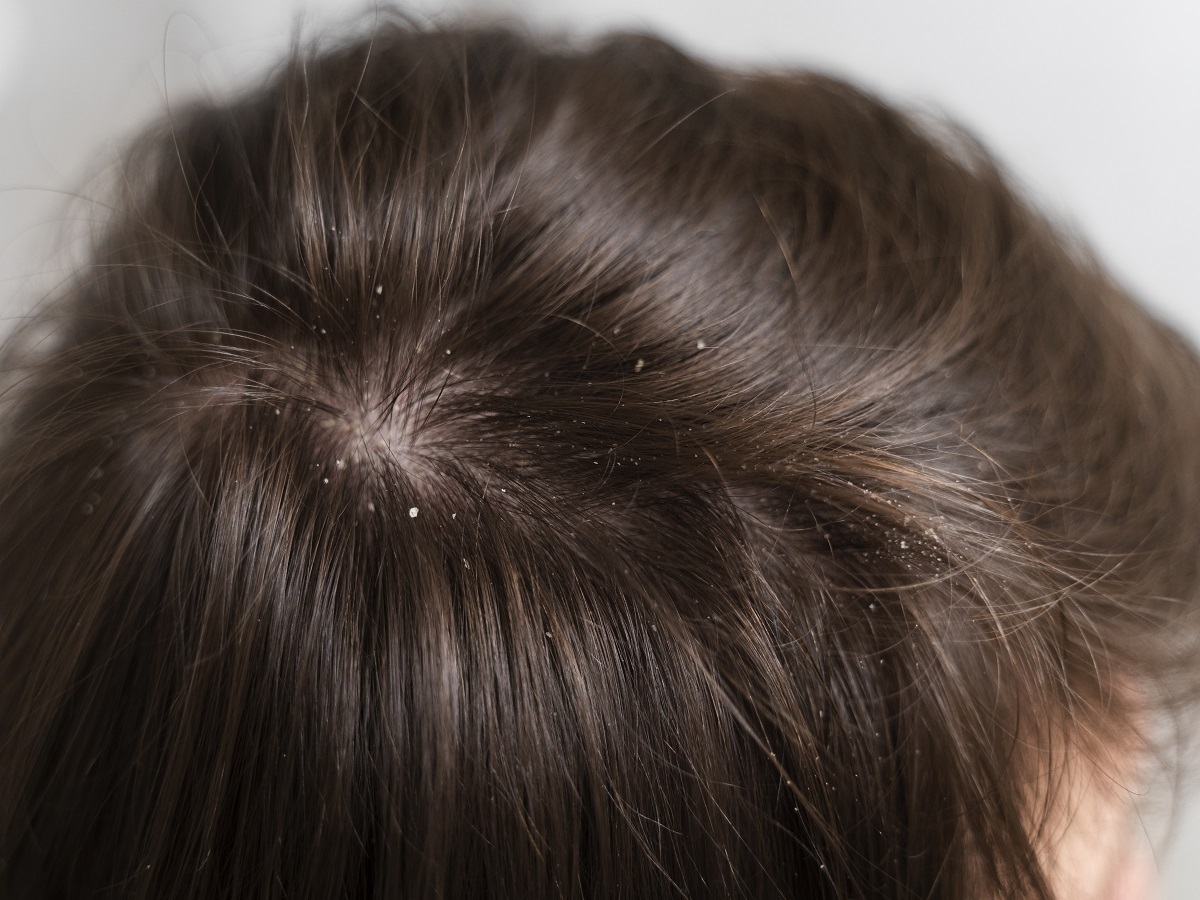 7 Steps To Control Dandruff During Winters