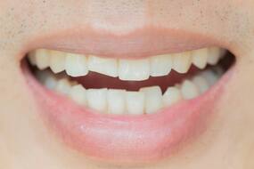 4 Treatments For A Cracked Tooth
