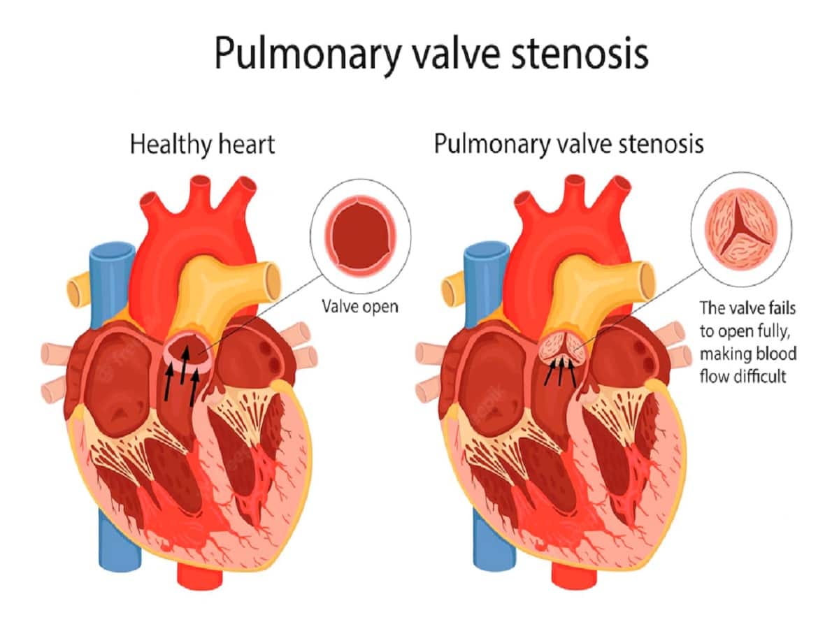 Blood Clots, Heart Failure, Stroke Neglecting Heart Valve Disease Can