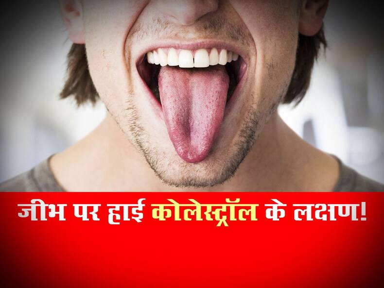 नसों में कोलेस्ट्रॉल भर जाने पर जीभ का रंग हो जाता है ऐसा! जानें High cholesterol में जीभ पर दिखने वाले 2 लक्षण