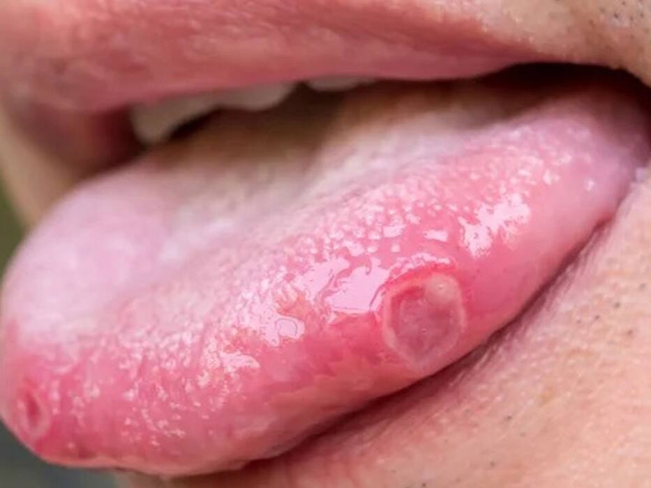 जीभ पर दिखाई देने वाले ये लक्षण देते हैं HIV का संकेत! इस तरह पहचानें क्या आपको भी हुई ये खतरनाक बीमारी