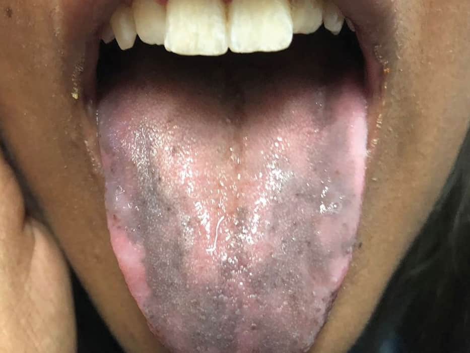 जीभ पर दिखाई देने वाले ये लक्षण देते हैं HIV का संकेत! इस तरह पहचानें क्या आपको भी हुई ये खतरनाक बीमारी