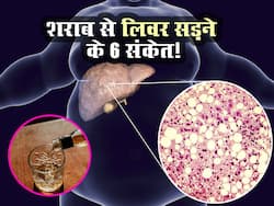 शराब पी-पीकर सड़ गया है आपका लिवर बताते हैं ये 6 संकेत! जानें किस संकेत से लगेगा पता शराब ने बिगाड़ा आपका लिवर