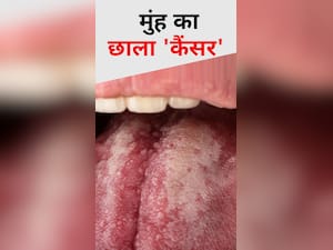 मुंह के छाले कहीं कैंसर' तो नहीं?