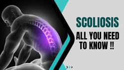 Scoliosis: Why Children Are Most Commonly Diagnosed With Scoliosis, All You Need To Know About The Condition !! Watch Video