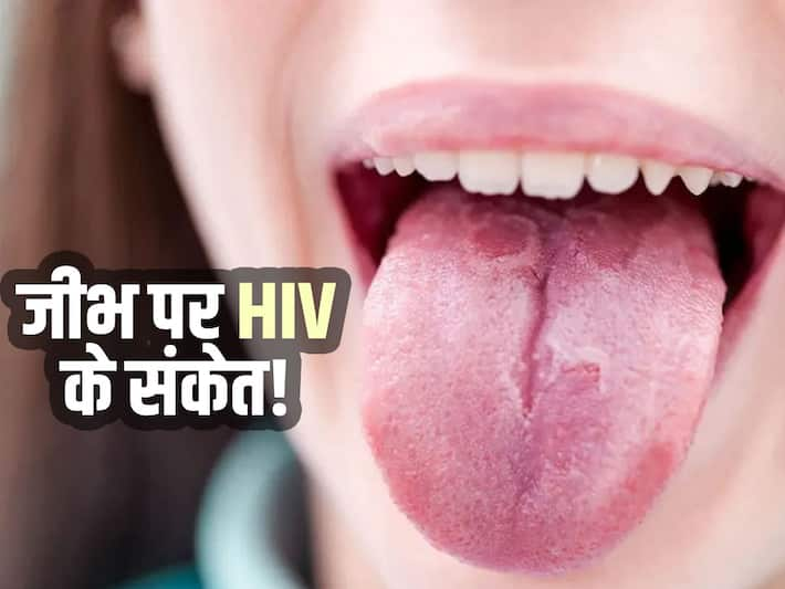 hiv-signs-on-tongue-hiv