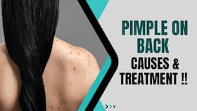 Pimple On Back & Shoulders: Home Remedies To Remove Acne & Pimple From Your Body, Watch Video