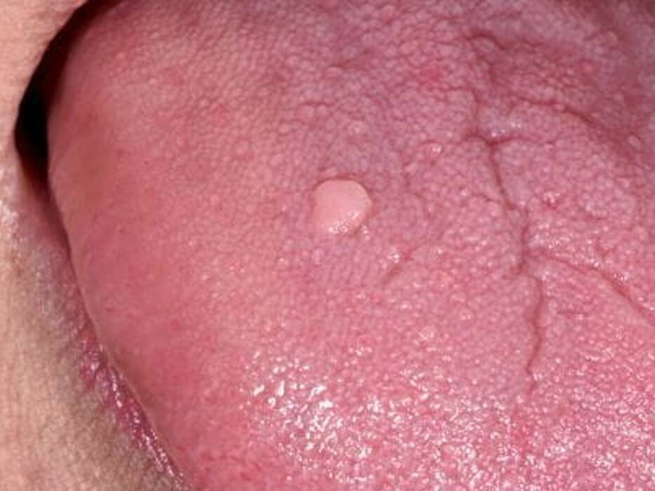 जीभ पर दिखाई देने वाले ये लक्षण देते हैं HIV का संकेत! इस तरह पहचानें क्या आपको भी हुई ये खतरनाक बीमारी