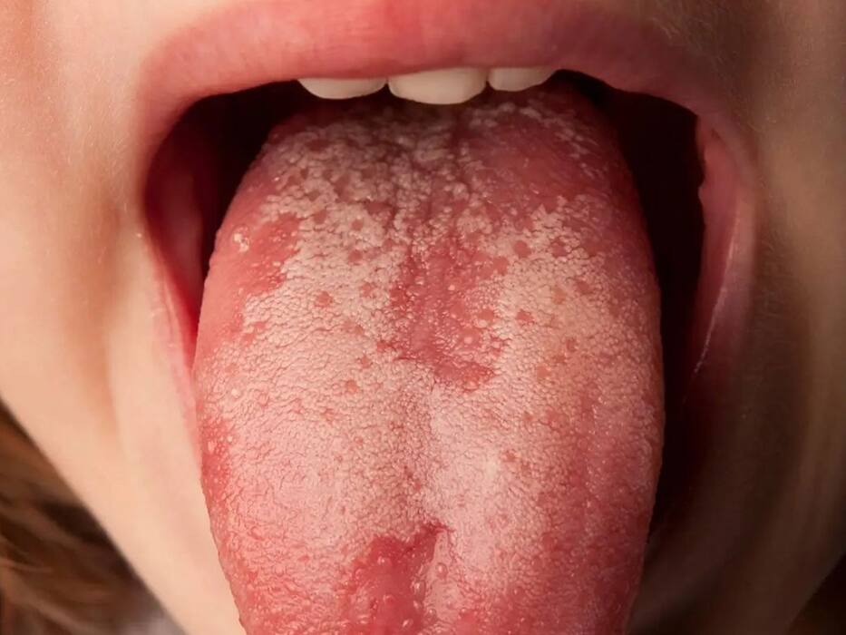 जीभ पर दिखाई देने वाले ये लक्षण देते हैं HIV का संकेत! इस तरह पहचानें क्या आपको भी हुई ये खतरनाक बीमारी