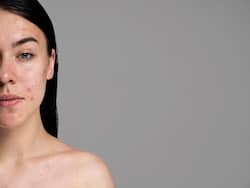 Facing Skin Issues? It Could Be Fungal Acne!