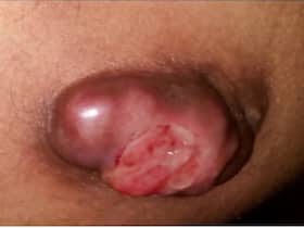 Leuco Sarcoma cancer: 4cm Tumor Removed From A 38-Year-Old Man   s Buttock