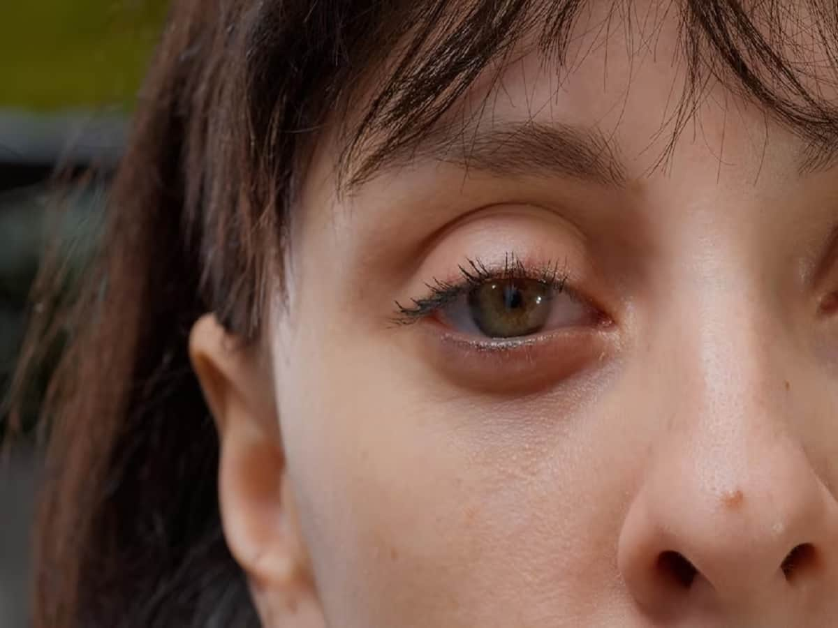 10 Natural Ways To Get Rid Of Bags Under The Eyes