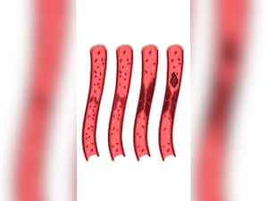 Watch Out for These Signs Of Blood Clots