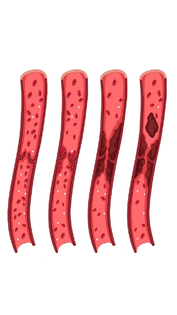 Watch Out for These Signs Of Blood Clots