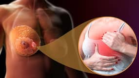 1.6 Kg Tumour Removed From Woman's Breast: How Doctors Gave 42-Year Breast Cancer Patient A New Lease of Life 1.6 Kg Tumour Removed From Woman's Breast: How Doctors Gave 42-Year Breast Cancer Patient A New Lease of Life