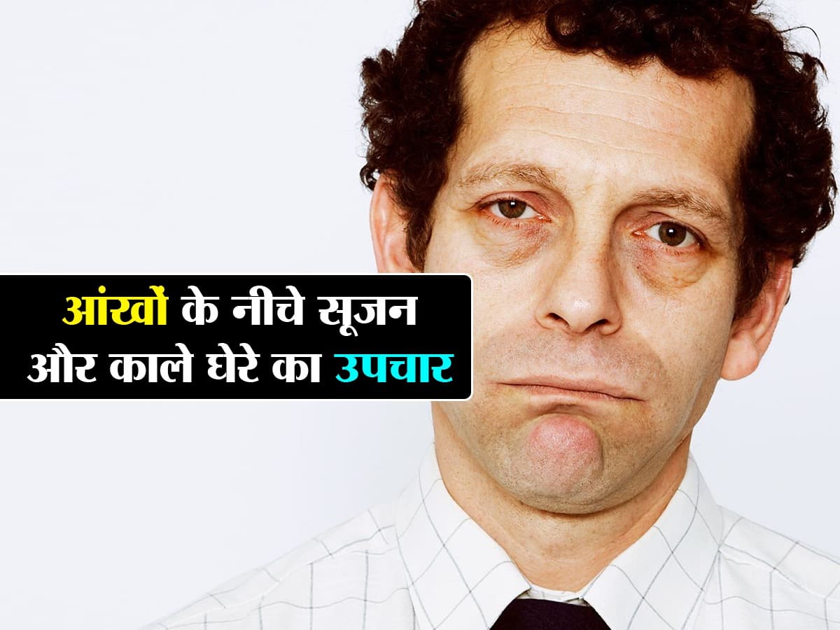 How to Remove Eye Bags Permanently In Hindi हमेशा के लिए आई बैग्स से