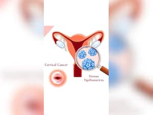 Human Papillomavirus: A Primary Cause Of Cervical Cancer