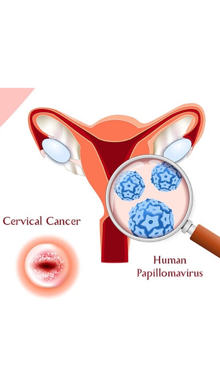 Human Papillomavirus: A Primary Cause Of Cervical Cancer