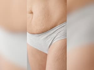 स्ट्रेच मार्क्स दूर करने के 6 घरेलू उपाय