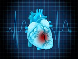 High Blood Pressure, Obesity And Other Risk Factors For Atrial Fibrillation (Afib)