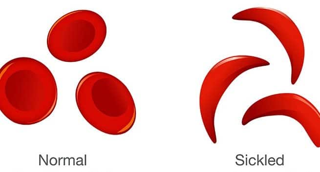 Sickle Cell Anemia