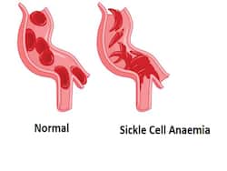 Identifying The Difference Between Anaemia And Sickle Cell Anaemia