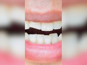 7 Types Of Cracked Teeth