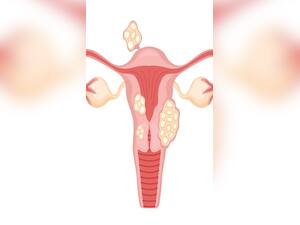 What Factors Can Aggravate Cervical Cancer?
