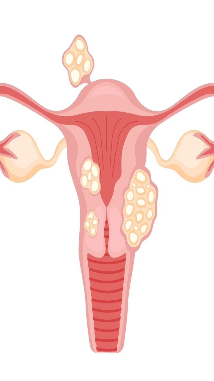 What Factors Can Aggravate Cervical Cancer?